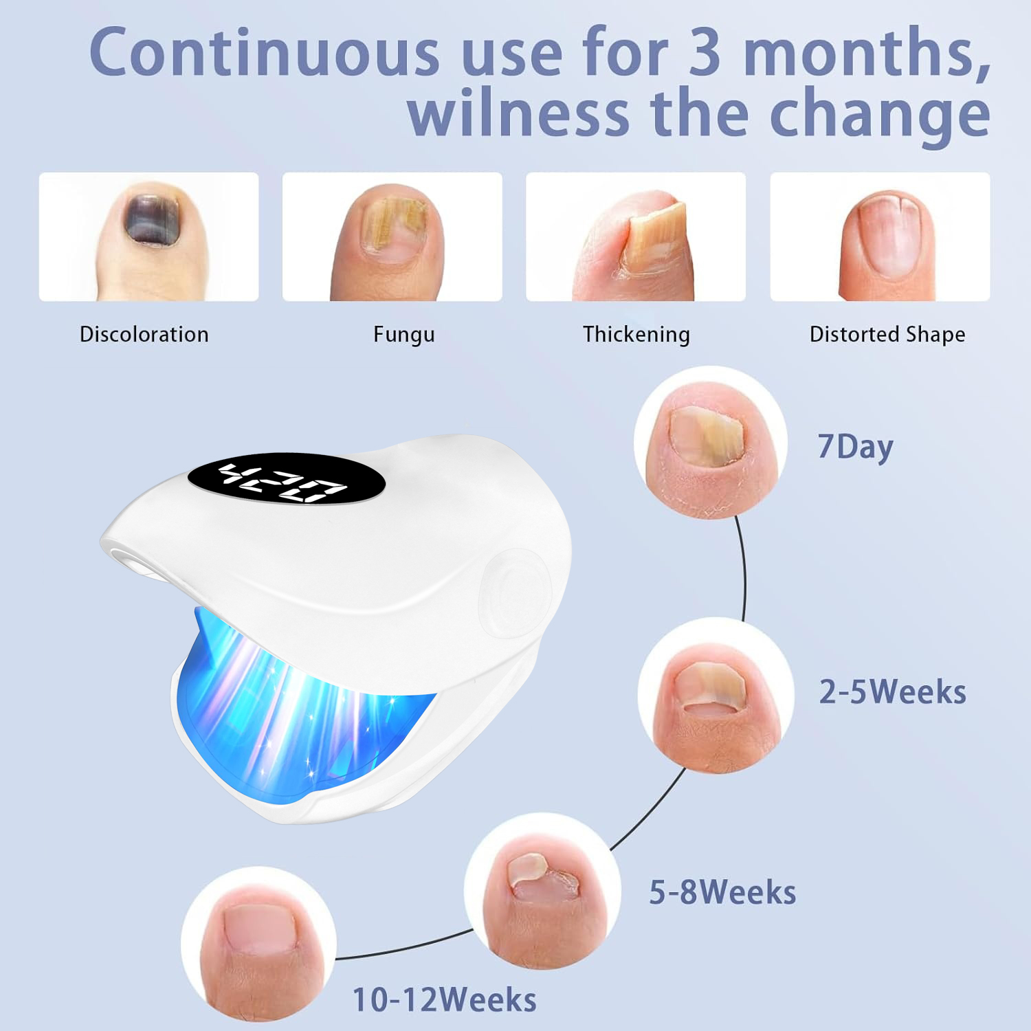 Effective Nail Fungus Removal  - Industrial Laser Removal 评论和价格